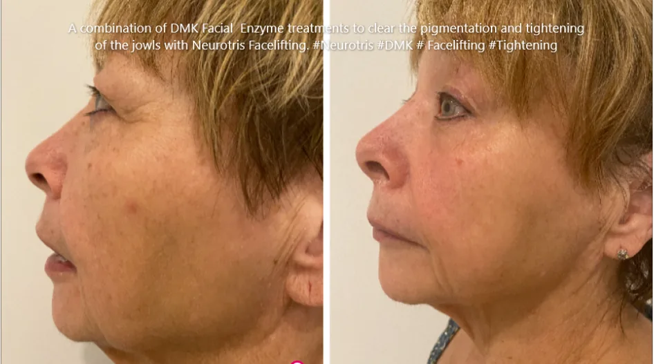 Before and after DMK enzyme therapy with Neurotris facelifting, showing reduced pigmentation and a tighter jawline