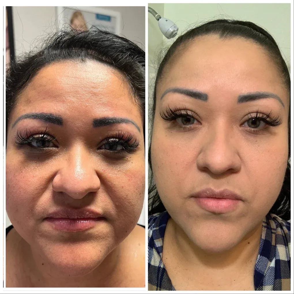 Before and after a treatment series showing clearer, more even skin tone and smoother texture